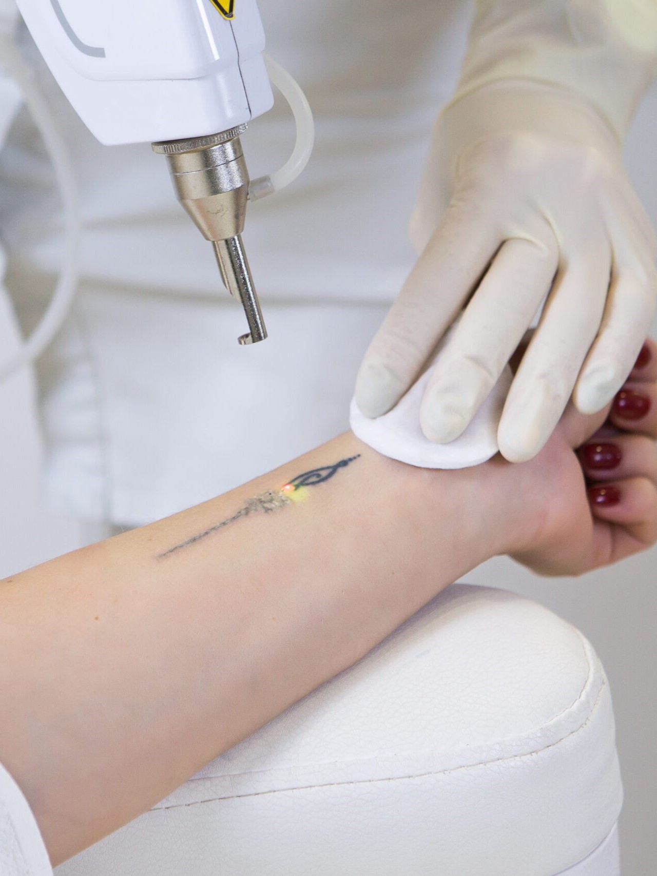 Tattoo+laser+removing+